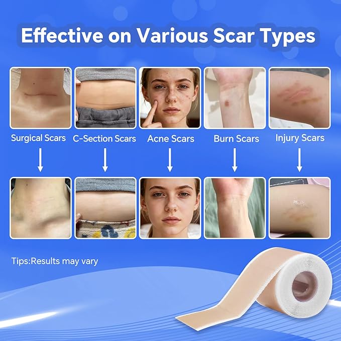 Professional Silicone Scar Sheets, Silicone Scar Tape, Silicone Scar Patch, Reusable Scar Silicone Strips (1.5M)