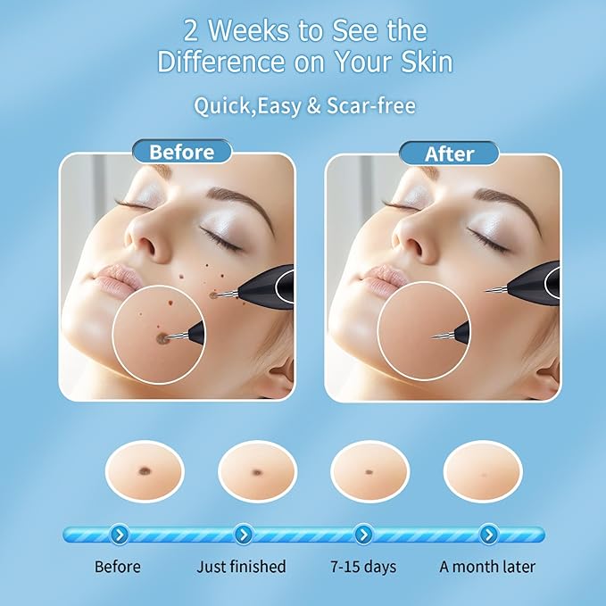 Skin Clinic Freeze Point for Warts and Skin Tags, GJW-02